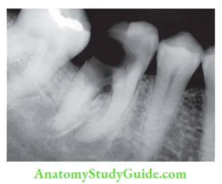 Case Selection And Treatment Planning Mandibular fist molar with extensive root and furcation caries is poor candidate for endodontic treatment.
