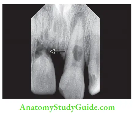 Case Selection And Treatment Planning Radiograph showing extensive external resorption of maxillary right central incisor; not indicated for endodontic treatment.