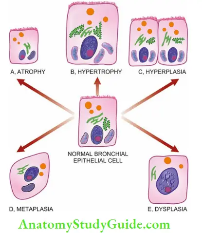 Cellular Adaptations And Cell Injury Adaptive Disorders Of Growth