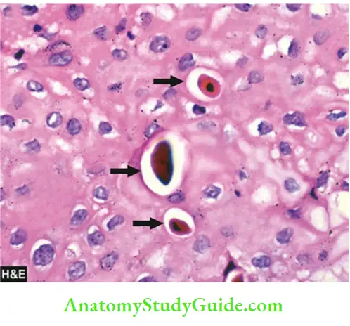 Cellular Adaptations And Cell Injury Apoptotic Bodies In The Layer Of Squamous Mucosa