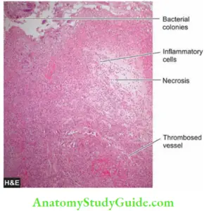 Types Of Gangrene And Their Symptoms - Anatomy Study Guide