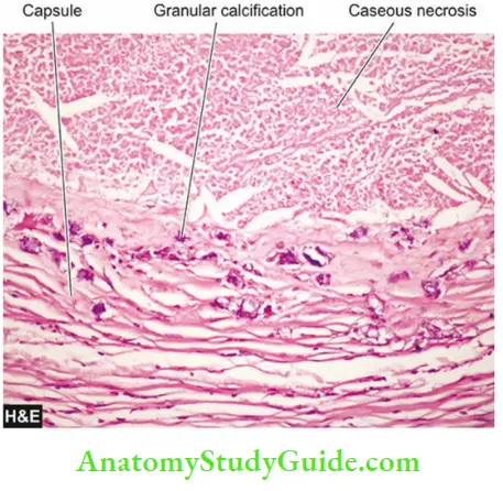 Pathologic Calcification Notes - Anatomy Study Guide