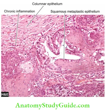 Cellular Adaptations And Cell Injury Squamous Metaplasia Of The Uterine Cervix