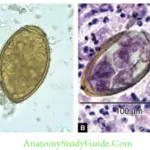 Cestodes and Trematodes Eggs of Paragonimus species. A. In sputum—wet mount; B. In lung biopsy—stained with hematoxylin