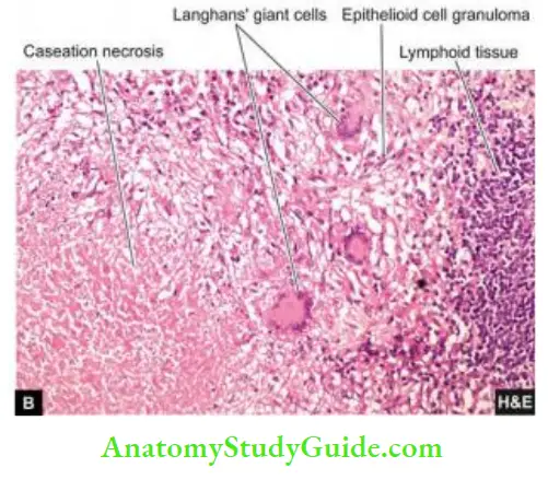 Chronic Inflammation Causes Symptoms and Treatment Caseating Epithelioid Cell Granulomas with A few Langhans Giant Cells