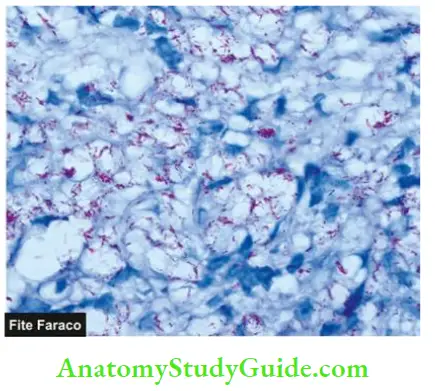 Chronic Inflammation Causes Symptoms and Treatment Lepra Bacilli In LL Are Seen As Globi And Cigarettes