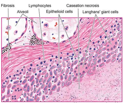 Complications Of Secondary Pulmonary Tuberculosis - Anatomy Study Guide