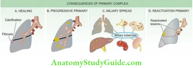 Chronic Inflammation Causes Symptoms and Treatment Possible Consequences Of Primary Complex