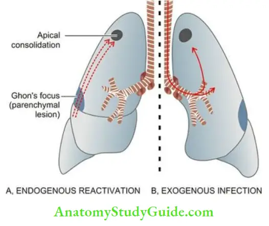 Chronic Inflammation Causes Symptoms and Treatment Progressive Secondary Tuberculosis