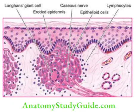 Immunopathogenesis Of Leprosy Notes - Anatomy Study Guide