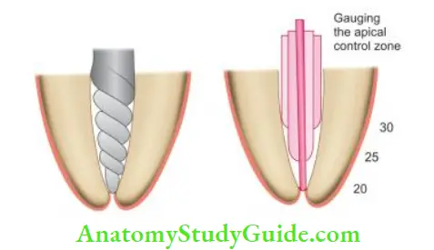 Cleaning And Shaping Of Root Canal System Apical gauging of root canal. Diagrammatic representation of apical gauging.