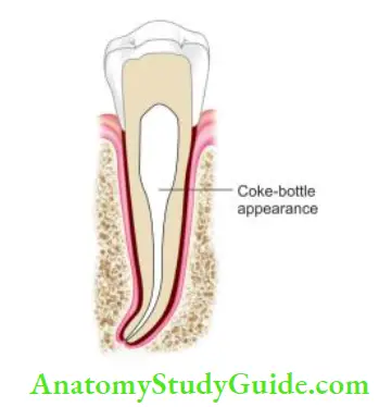 Cleaning And Shaping Of Root Canal System “Coke-bottle appearance” caused by over use of Gates glidden drills.
