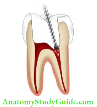 Cleaning And Shaping Of Root Canal System Direct the small round bur to assumed pulp space.