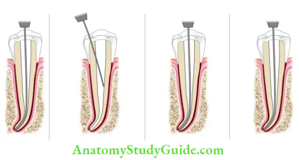 Cleaning And Shaping Of Root Canal System Double flre technique