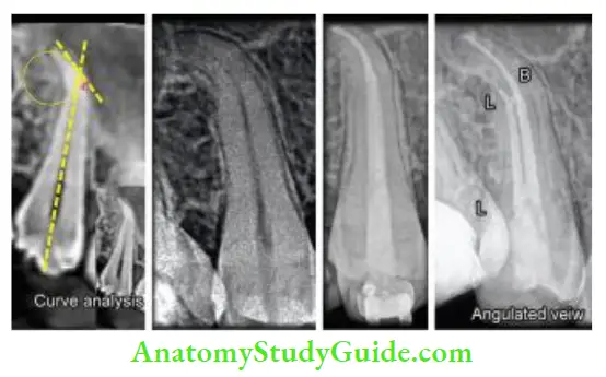 Cleaning And Shaping Of Root Canal System Endodontic treatment of maxillary premolar with curved canals.