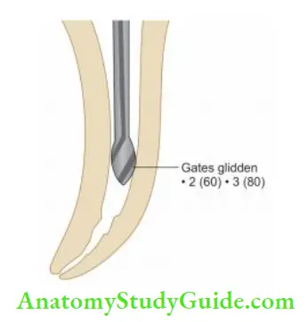 Cleaning And Shaping Of Root Canal System Gates-glidden drill is used to prepare the coronal one-third of the canal.