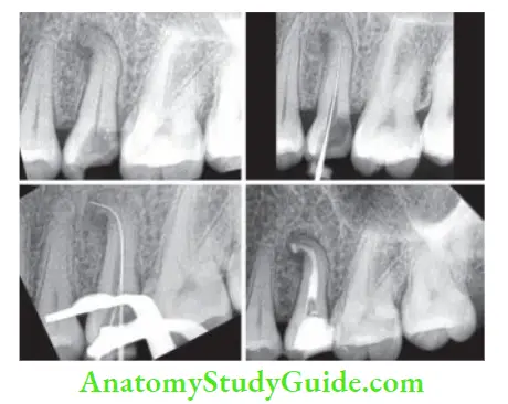 Cleaning And Shaping Of Root Canal System Management of dilacerated roots of maxillary second premolar