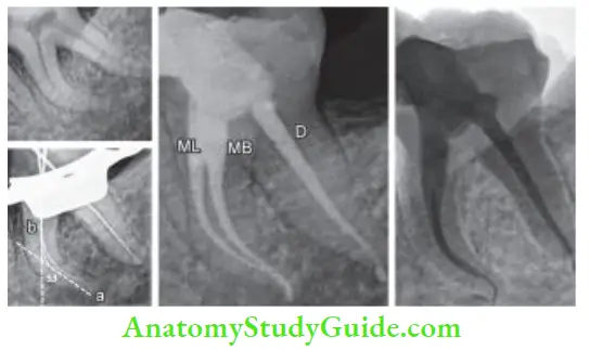 Cleaning And Shaping Of Root Canal System Management of mandibular molar with curved canals