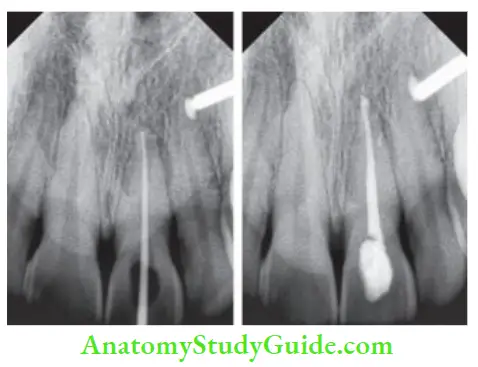Cleaning And Shaping Of Root Canal System Master cone radiograph;Postobturation radiograph