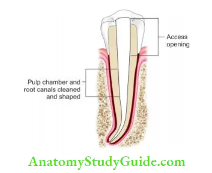 Cleaning And Shaping Of Root Canal System Notes cleaned and shaped root canal system.