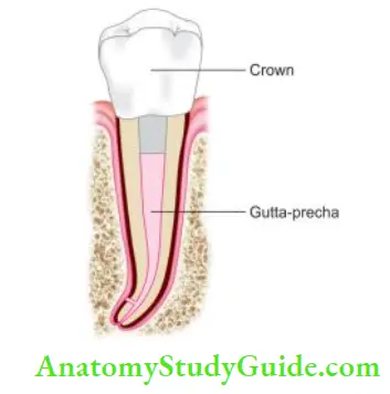 Cleaning And Shaping Of Root Canal System Obturation of root canals followed by crown placement.