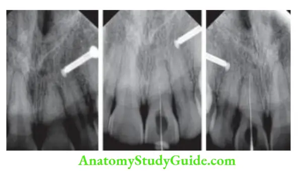 Cleaning And Shaping Of Root Canal System Preoperative radiograph; Explore the canal using #10 fie; Working length radiograph