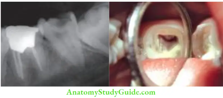 Cleaning And Shaping Of Root Canal System Preoperative radiograph; after access preparation