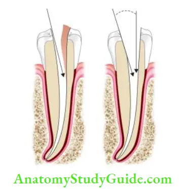 Cleaning And Shaping Of Root Canal System Removal of overlying dentin causes smooth internal walls and provides straight-line access to root canals.