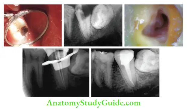 Cleaning And Shaping Of Root Canal System Root canal treatment of mandibular second molar with C-shaped canals.