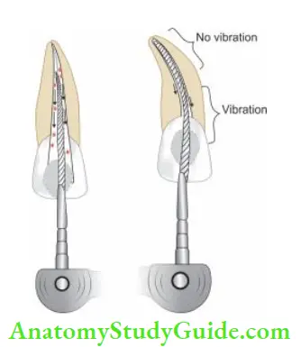 Cleaning And Shaping Of Root Canal System Ultrasonic instrument and irrigation work actively in straight canal; Curvature in canal may impede vibration.