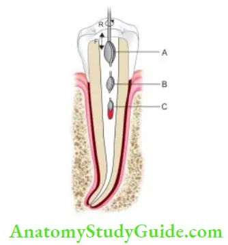 Cleaning And Shaping Of Root Canal System Use of Gates-glidden for preflring.