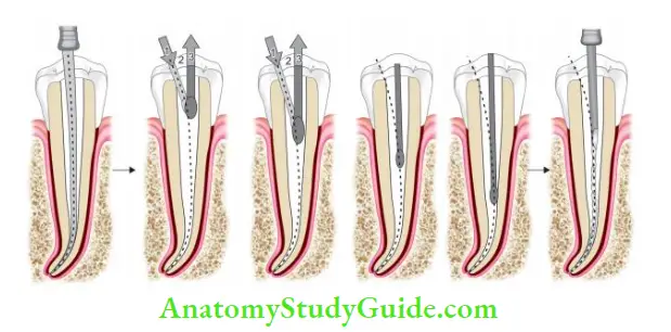 Cleaning And Shaping Of Root Canal System crown down technique