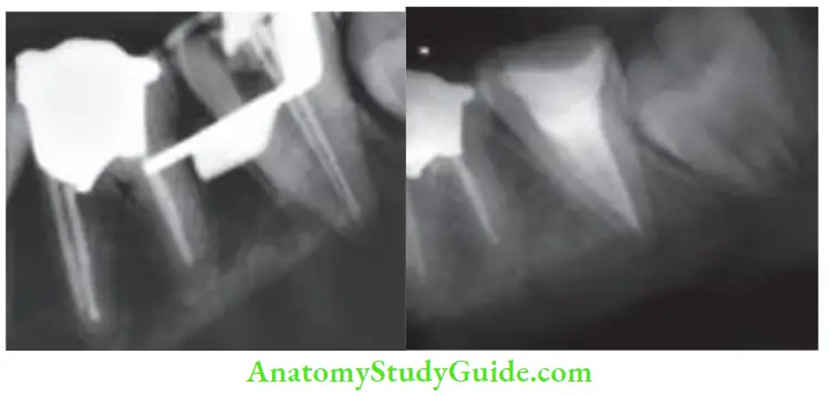 Cleaning And Shaping Of Root Canal System working length radiograph; postobturation radiograph.
