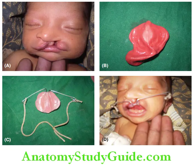 Cleft Lip And Cleft Palate A 5 days old baby with cleft lip and palate
