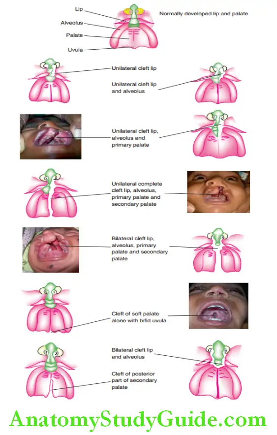 Cleft Lip And Cleft Palate Different clinical presentataions of cleft lip and left palate