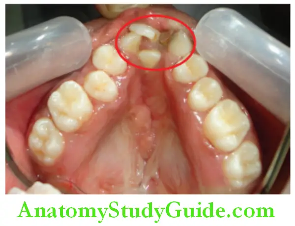 Cleft Lip And Cleft Palate cleft between central incisor and canine red circle