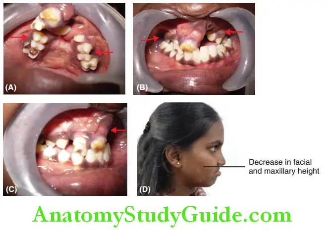 Cleft Lip And Cleft Palate growth retardation of maxilla in all the three dimensions