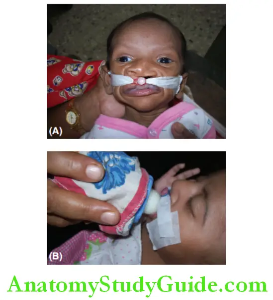 Cleft Lip And Cleft Palate nasoalveloar moulding plate strapped to the infants cheeks with adhesive tepes