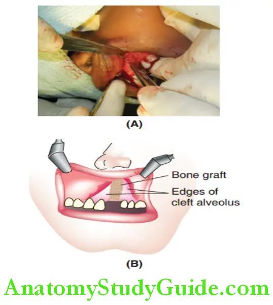 Cleft Lip And Cleft Palate secondary alveolar bone graft