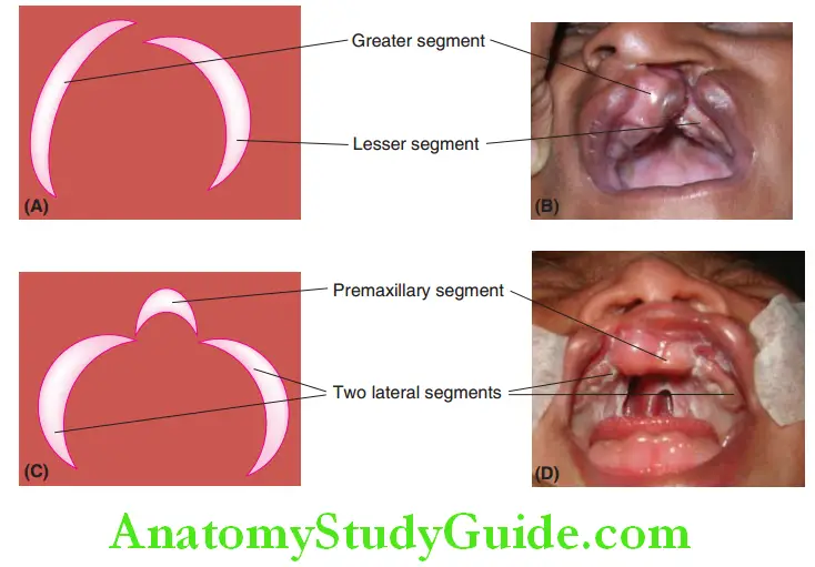 Cleft Lip And Cleft Palate unilateral cleft palate with two unequal segments of the alveolus