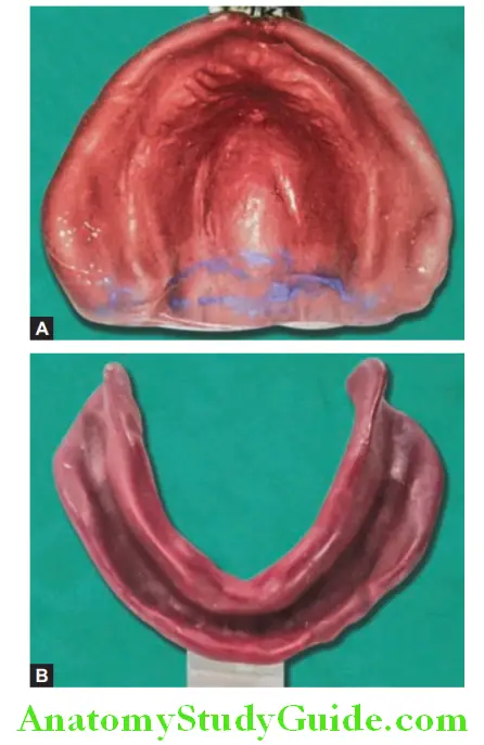 Complete Denture Impression primary edentulous impression made with alginate