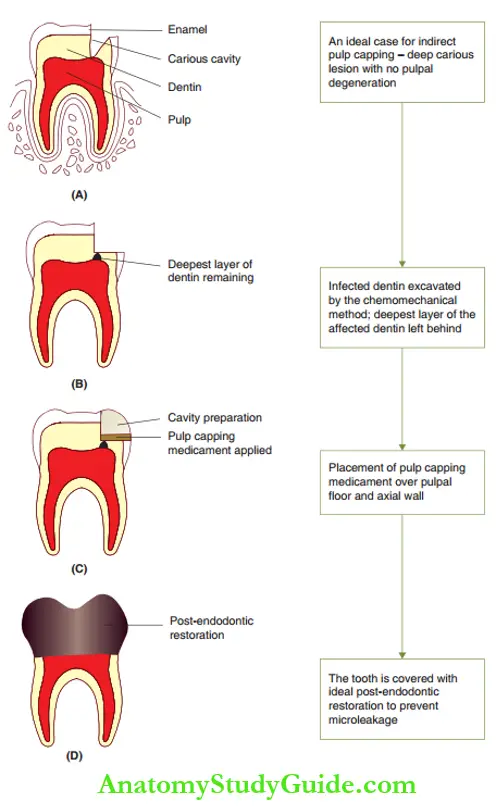 Conservative Endodontic Therapy In Primary Teeth Indirect Pulp Capping Procedure