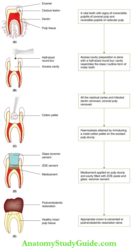Conservative Endodontic Therapy In Primary Teeth Pulpotomy Procedure
