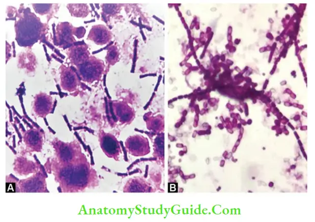 Corynebacterium And Bacillus Gram-stain of B. anthracis A. Direct smearshows gram-positive, large rectangular bacilli and pus cells; B.