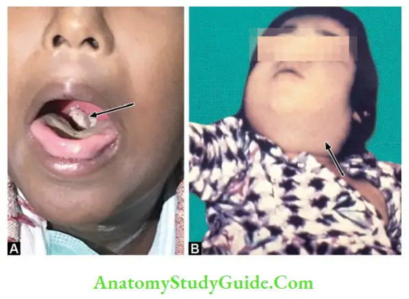 Corynebacterium And Bacillus Pseudomembrane covering the tonsils classically seen in diphtheria and B. Bull neck appearance (arrow)
