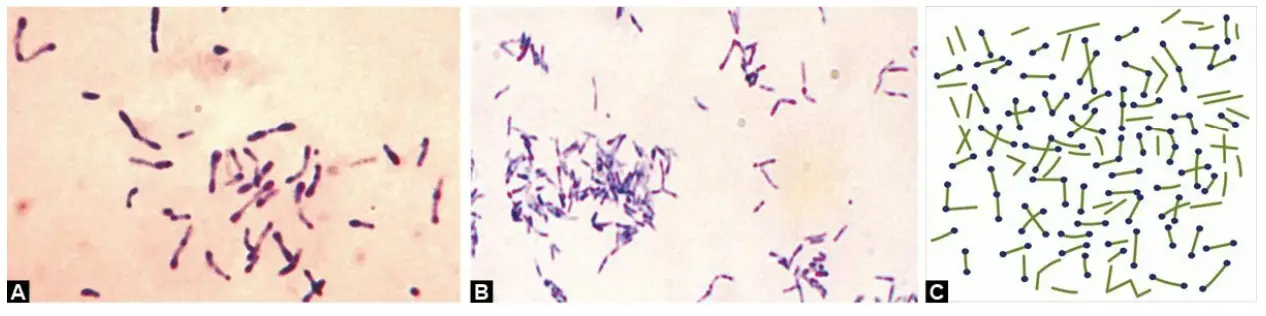 Corynebacterium diphtheriae. A. Club-shaped bacilli in methylene blue-stained smear; B. Gram-stained smear.