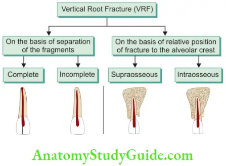 Crack Tooth Syndrome And Vertical Root Fracture Classification Of Vertical Root Fracture Flowchart