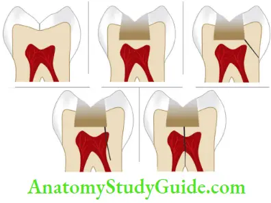 Crack Tooth Syndrome And Vertical Root Fracture Progression Chart Of Cracked Teeth Natural Tooth, Tooth With Large Restoration, Oblique Fracture, Fracture Reaching Pulp, Fracture Splitting Tooth