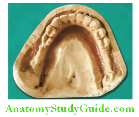 Dental Cast refractory cast