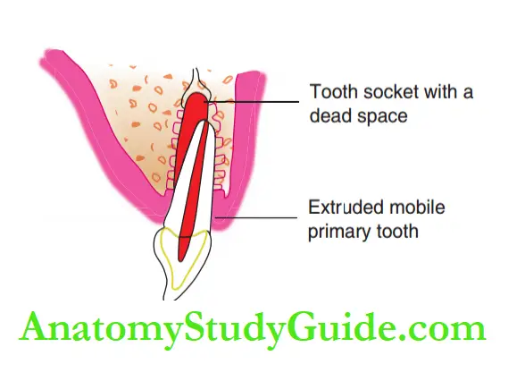 Dental Injuries in Primary Extruded primary tooth.
